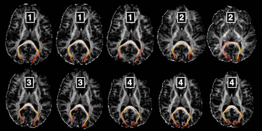 Tractography graphic