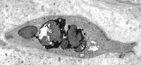 Lipids accumulation in smooth muscle cell in cerebral artery of Multiple System Atrophy case.