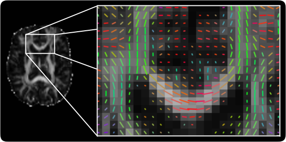 Diffusion MRI processed example